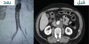 نجاح عملية إصلاح تمدد الشريان الأورطي البطني لمريض يبلغ من العمر 69 عامًا - شبكة أطلس سبورت